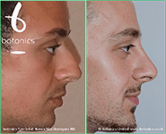non surgical nose job before and after