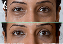 tear trough before and after
