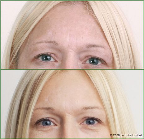 Botox around Eyes Before and After