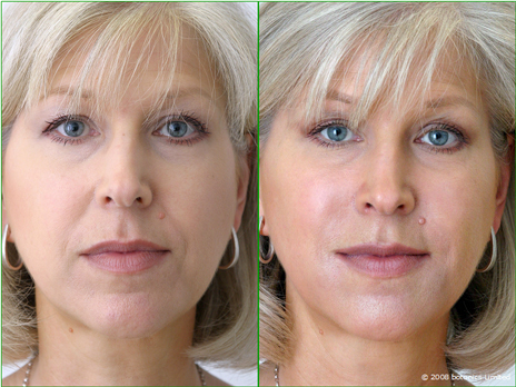 Jan_Before_After_Cheek_enhancement_Dermal_fillers_Lip_enhancement_a Jan - Before and After