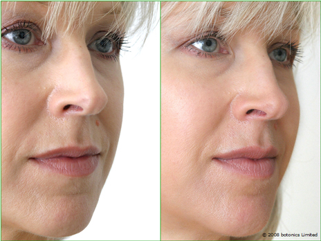 Jan_Large_Before_After_Left_Face_Cheek_enhancement_Dermal_fillers_Lip_enhancement_c