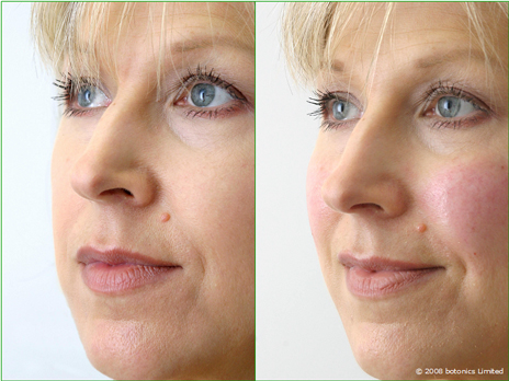 Jan_Large_Before_After_Right_Face_Cheek_enhancement_Dermal_fillers_Lip_enhancement_d