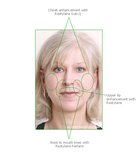 Jan_Treatment_Areas_Cheek_enhancement_Dermal_fillers_Lip_enhancement_b Jan - Breakdown