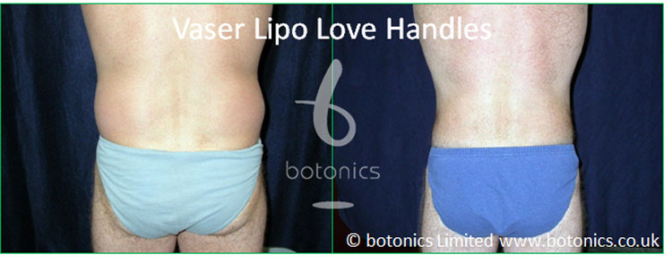 Vaser Lipo Liposelection Male Love Handles Before After Photo