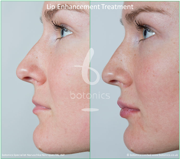 Lip Enhancement botonics