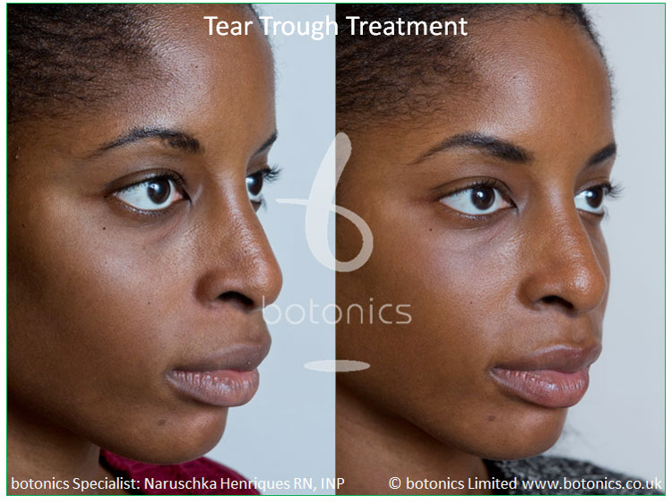tear trough young fillers before treatment henriques