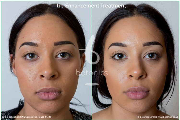 Upper Lip Enhancement botonics