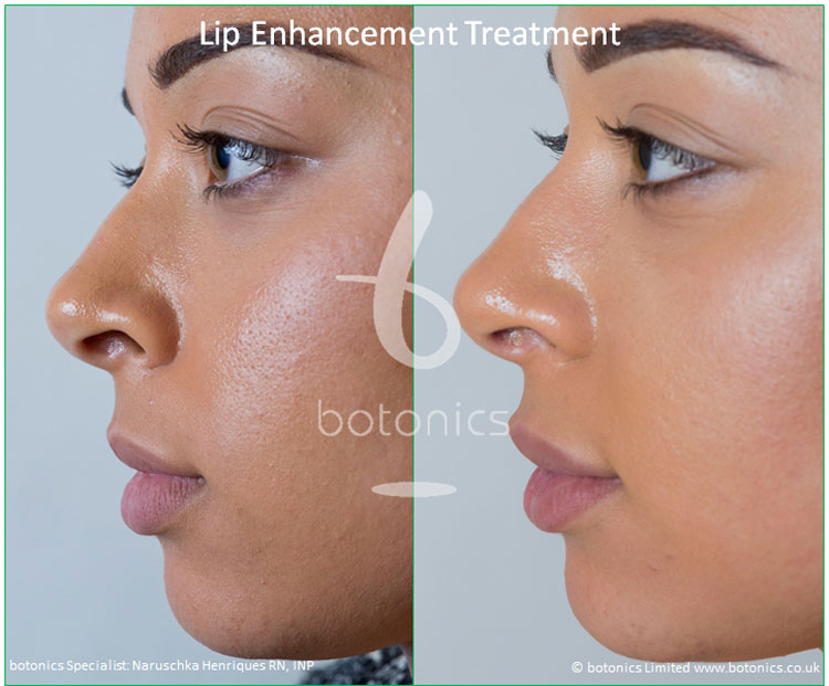 Upper Lip Enhancement botonics