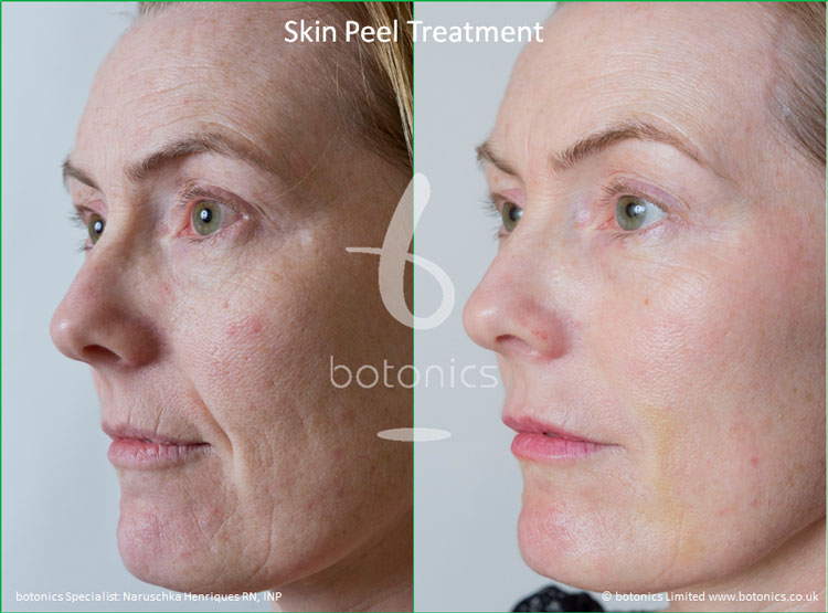 Skin Peel Treatment Before and After Pictures - botonics