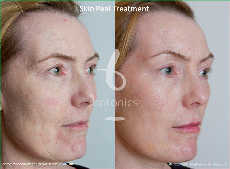 Skin Peel Treatment Before and After Pictures - botonics