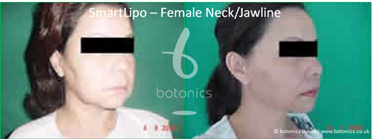 smartlipo laser lipo female neck jawline before and after photo botonics