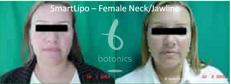 smartlipo laser lipo female neck jawline before and after photo botonics