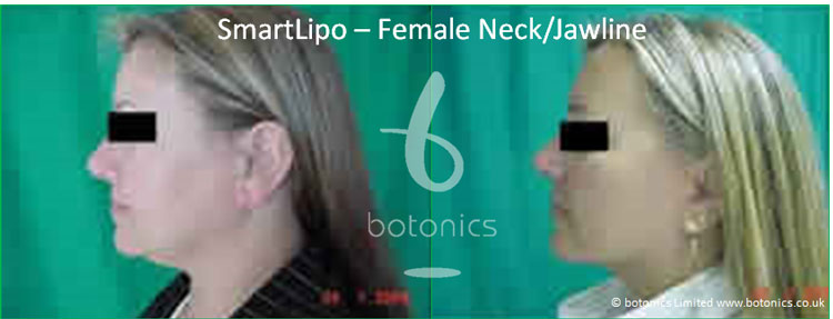 smartlipo laser lipo female neck jawline before and after photo botonics