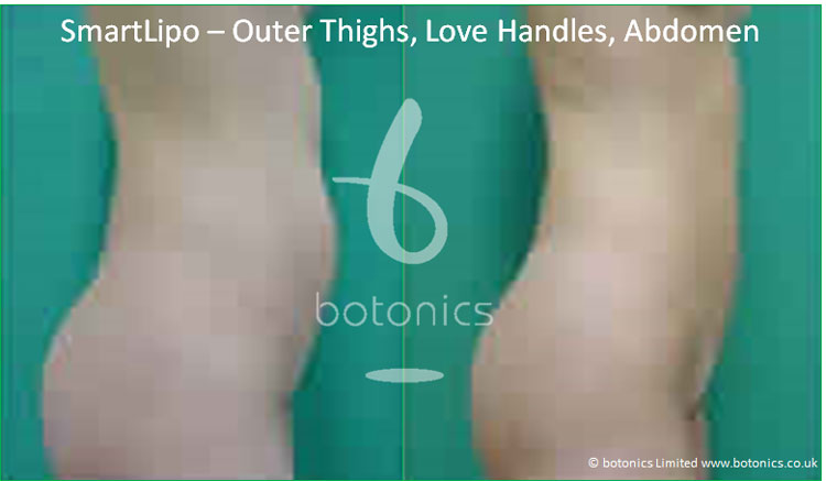 smartlipo laser lipo female outer thighs abdomen love handles before and after photo botonics