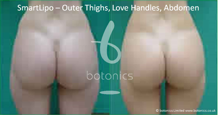 smartlipo laser lipo female outer thighs abdomen love handles before and after photo botonics