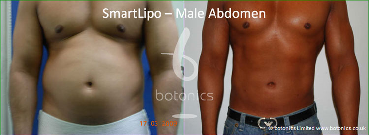 smartlipo laser lipo male abdomen love handles before and after photo botonics