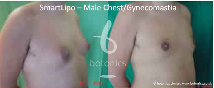 smartlipo laser lipo male chest gynecomastia before and after photo botonics