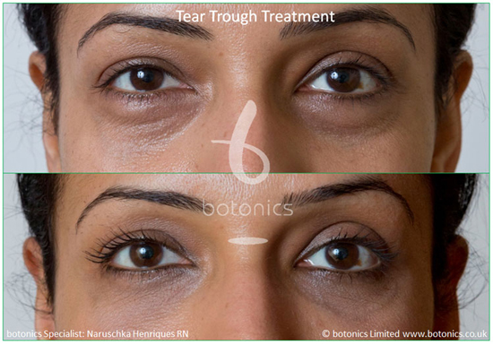 eye fillers cost uk