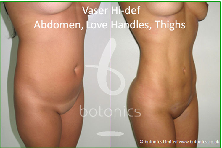 vaser lipo hi def female abdomen love handles thighs before and after 4 months photo botonics