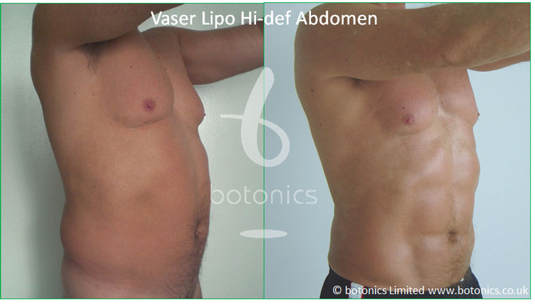vaser lipo hi def male abdomen before after botonics 1