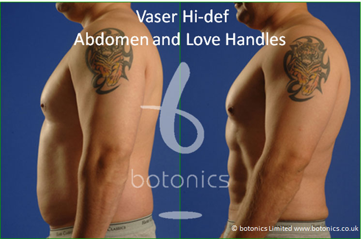 vaser lipo hi def male abdomen love handles before and after 4 months photo botonics