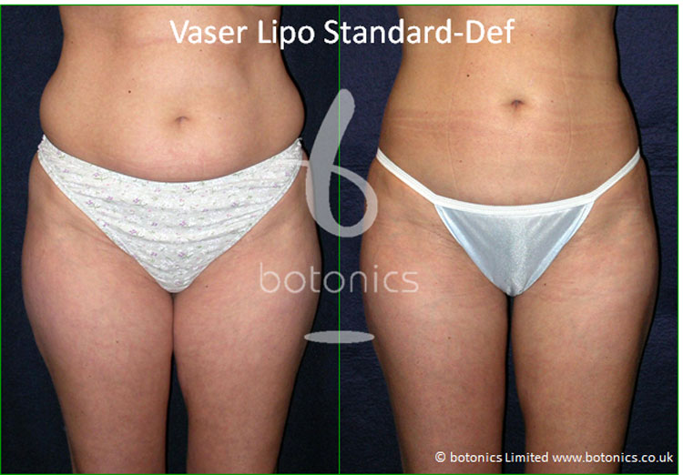 vaser lipo mid def liposelection female abdomen before and after photo botonics