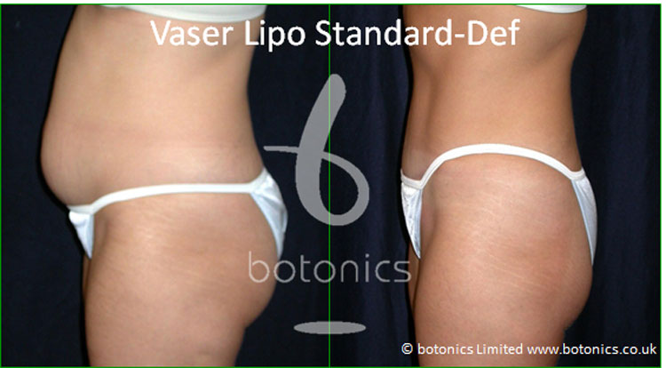 vaser lipo mid def liposelection female abdomen before and after photo botonics