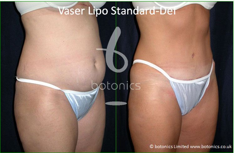 vaser lipo mid def liposelection female abdomen before and after photo botonics