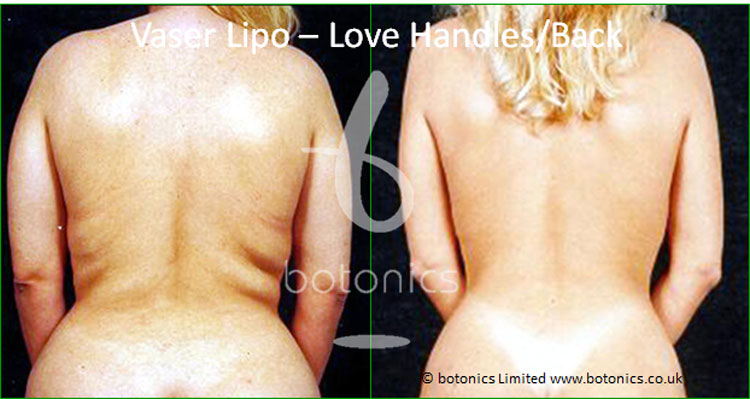 vaser lipo liposelection female back love handles before and after photo botonics