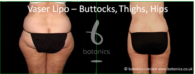 vaser lipo hi volume liposelection female buttocks thighs before and after photo botonics