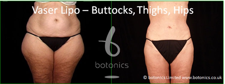 vaser lipo hi volume liposelection female buttocks thighs before and after photo botonics