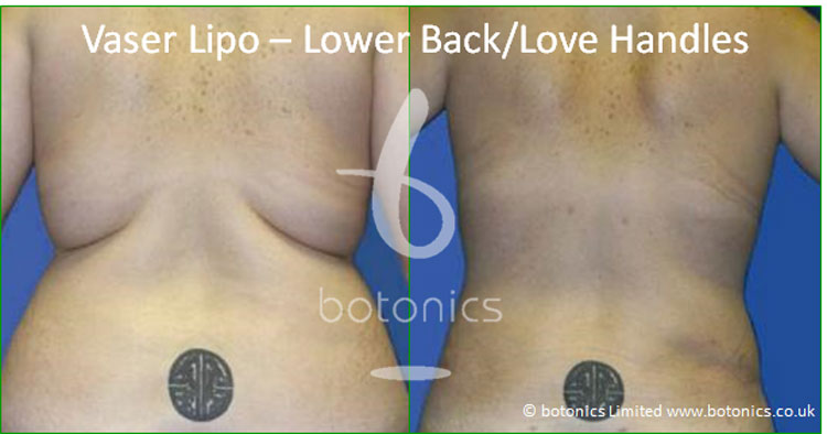 vaser lipo liposelection female lower back love handles before and after photo botonics