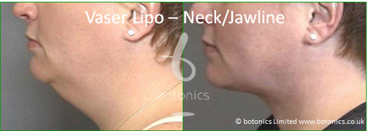 vaser lipo liposelection female neck jawline before and after photo botonics