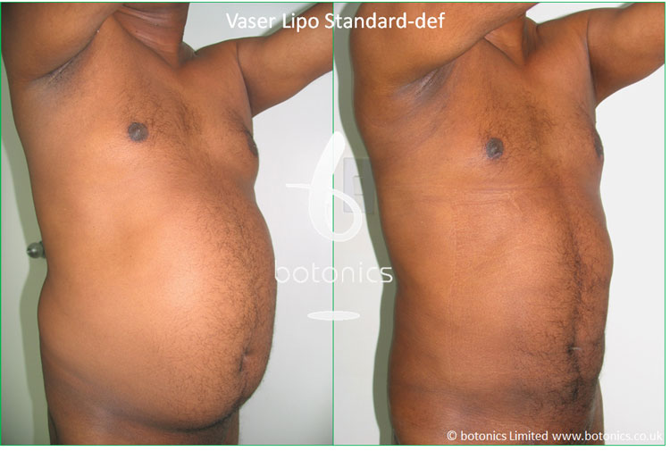 Alt text for Caption for Vaser Lipo standard-def hi-volume male abdomen