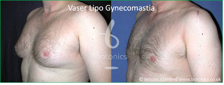 vaser lipo standard def male gynecomastia man boobs before after botonics