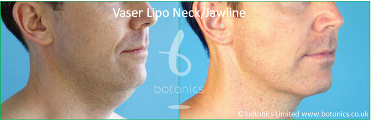 vaser lipo standard def male neck jawline chin before after botonics