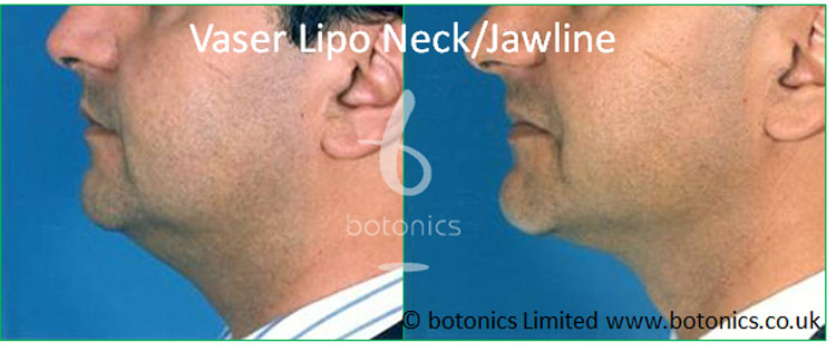 vaser lipo standard def male neck jawline chin before after botonics
