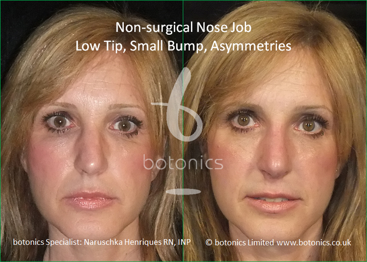 Latin Female Nose Enhancement botonics