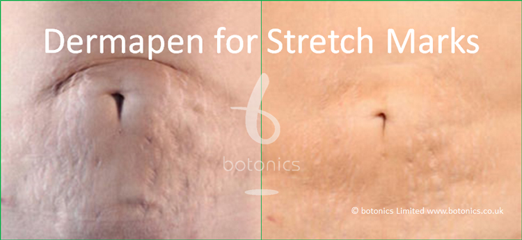 derma roller reviews post pregnancy derma roller reviews post pregnancy