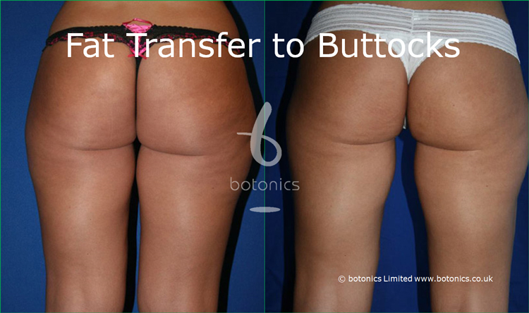 Fat Grafting To Buttocks 56