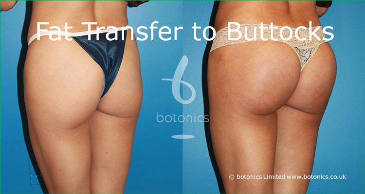 Fat Grafting To Buttocks 40