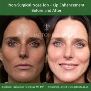 Before and after treatment for liquid rhinoplasty and lip enhancement using dermal filler