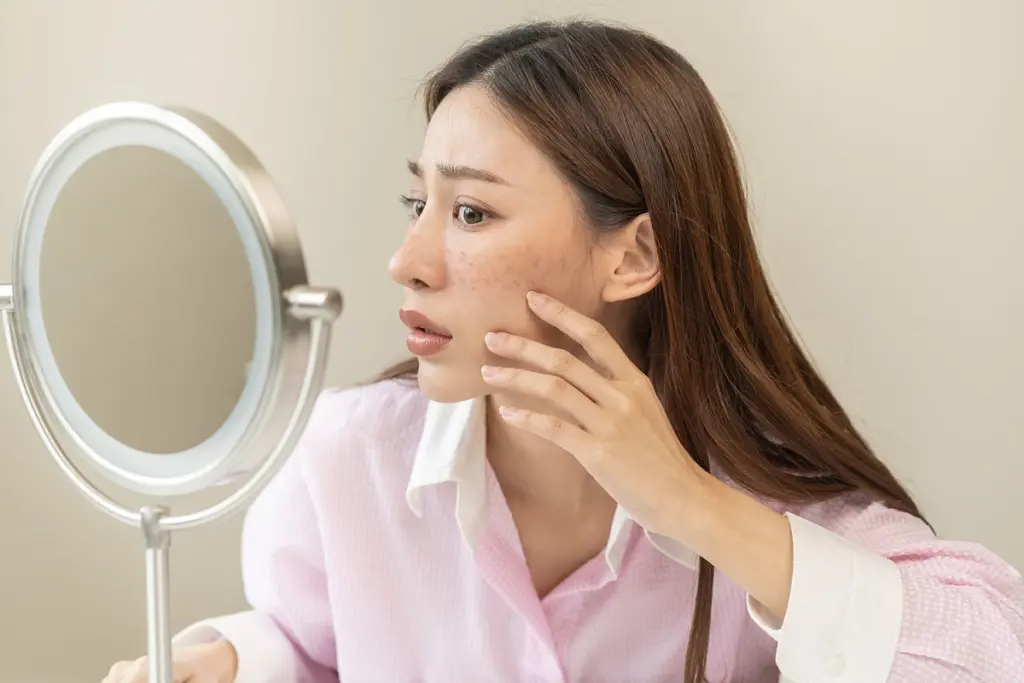 Does Roaccutane Permanently Cure Acne?
