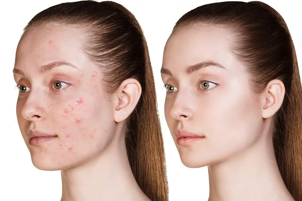 Is Roaccutane Treatment Right For Me?