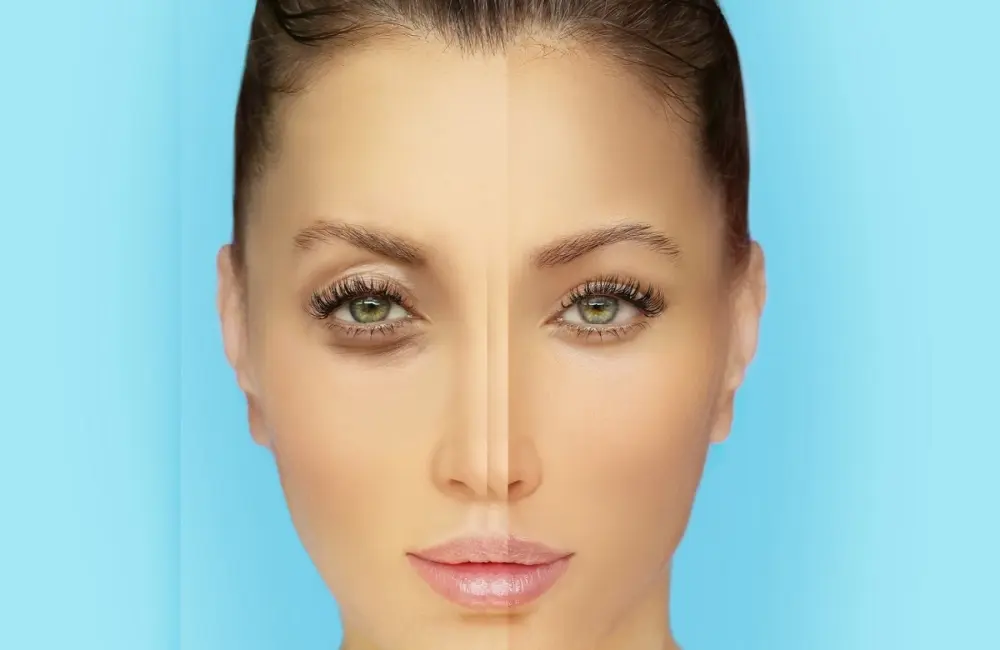 How Long Does Tear Trough Filler Last?