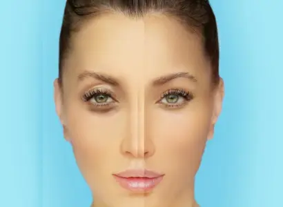 How Long Does Tear Trough Filler Last?