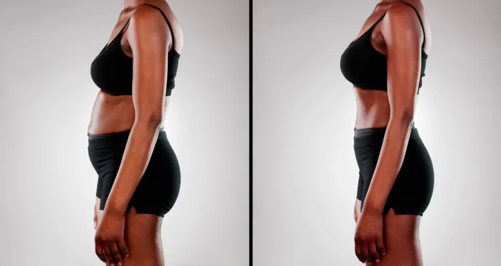 Understanding The Side Effects Of Vaser Liposuction