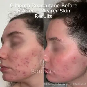 See the visible improvement in acne after 6 months of isotretinoin (Roaccutane) treatment for women.