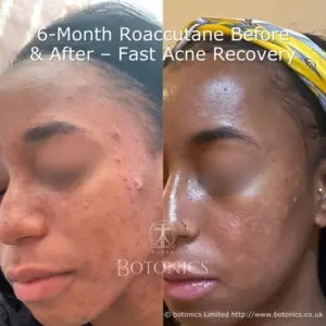 In just 6 months, isotretinoin (Roaccutane) showed a visible difference in acne-prone skin.