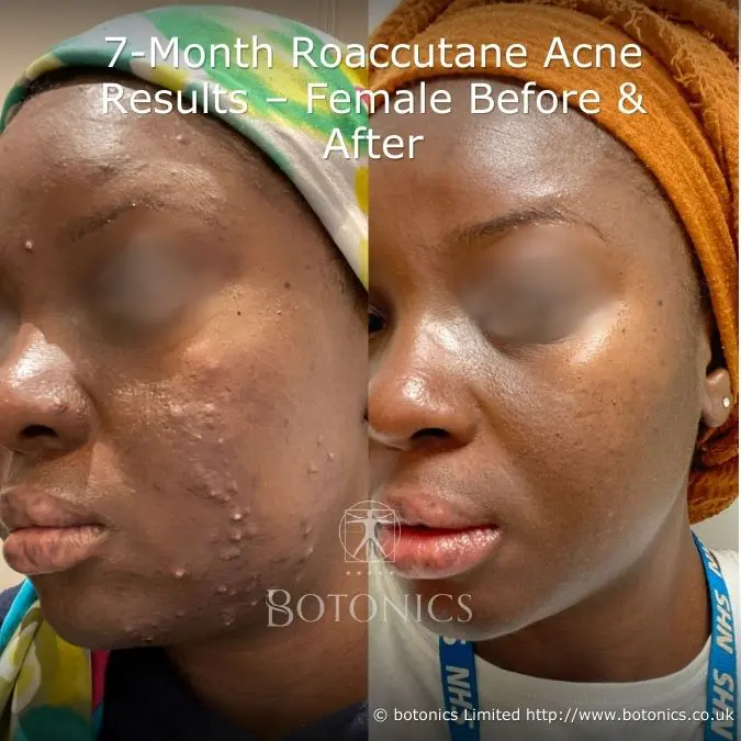7-month isotretinoin (Roaccutane) acne treatment results for women, showing a clear skin transformation.
